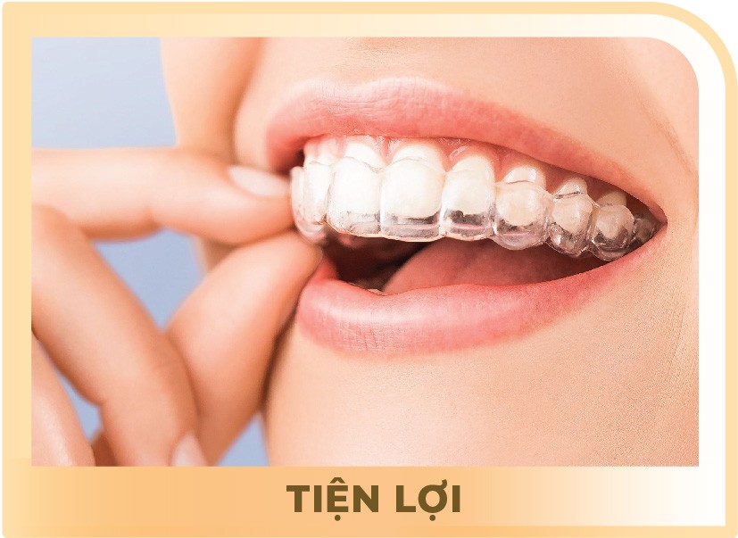 Niềng răng Invisalign không chỉ mang lại nụ cười đẹp mà còn giúp cải thiện sức khỏe răng miệng tổng thể.