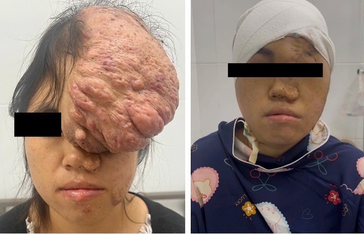 Phẫu thuật thành công khối u sụn xương sọ cho bệnh nhân dân tộc Mông