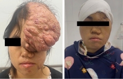 Phẫu thuật thành công khối u sụn xương sọ cho bệnh nhân dân tộc Mông
