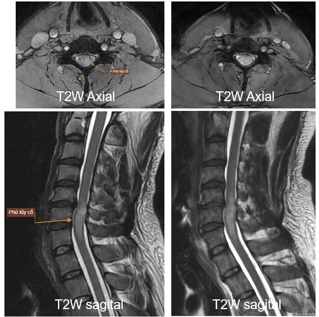 Hình ảnh chẩn đoán qua chụp MRI tại Bệnh viện Mặt Trời 
