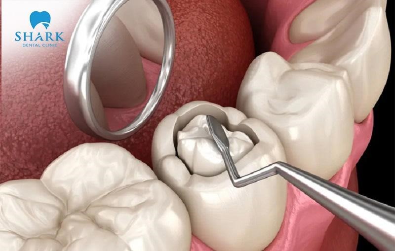 Trám răng tại Nha khoa Shark an toàn, hiệu quả, hạn chế các biến chứng