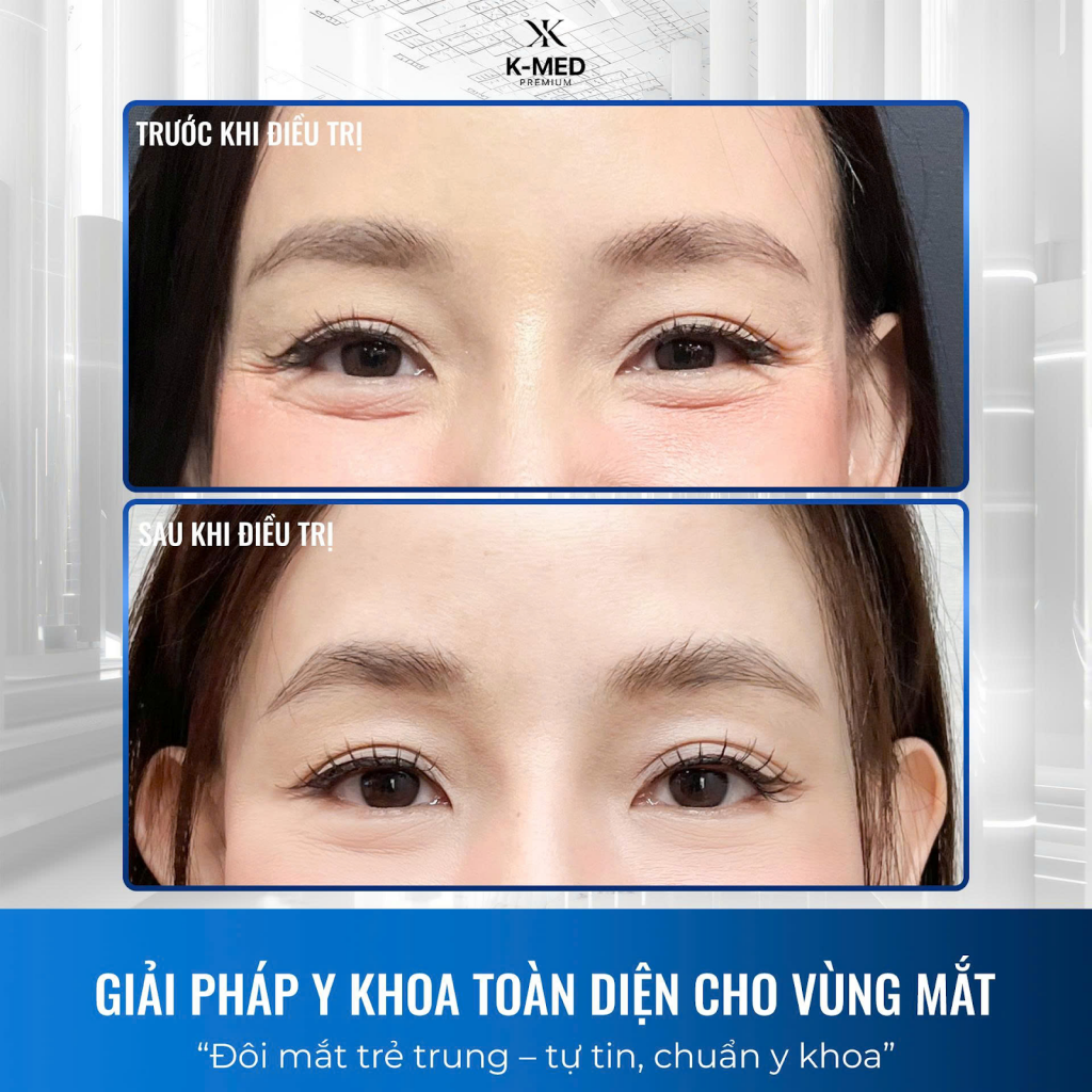 Liệu trình trẻ hóa vùng mắt tại K-MED – giải pháp y khoa giúp cải thiện rõ rệt nếp nhăn và bọng mắt.