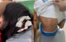 Xác minh thông tin bé gái lớp 5 nghi bị cha dượng bạo hành, cơ thể chi chít vết thương