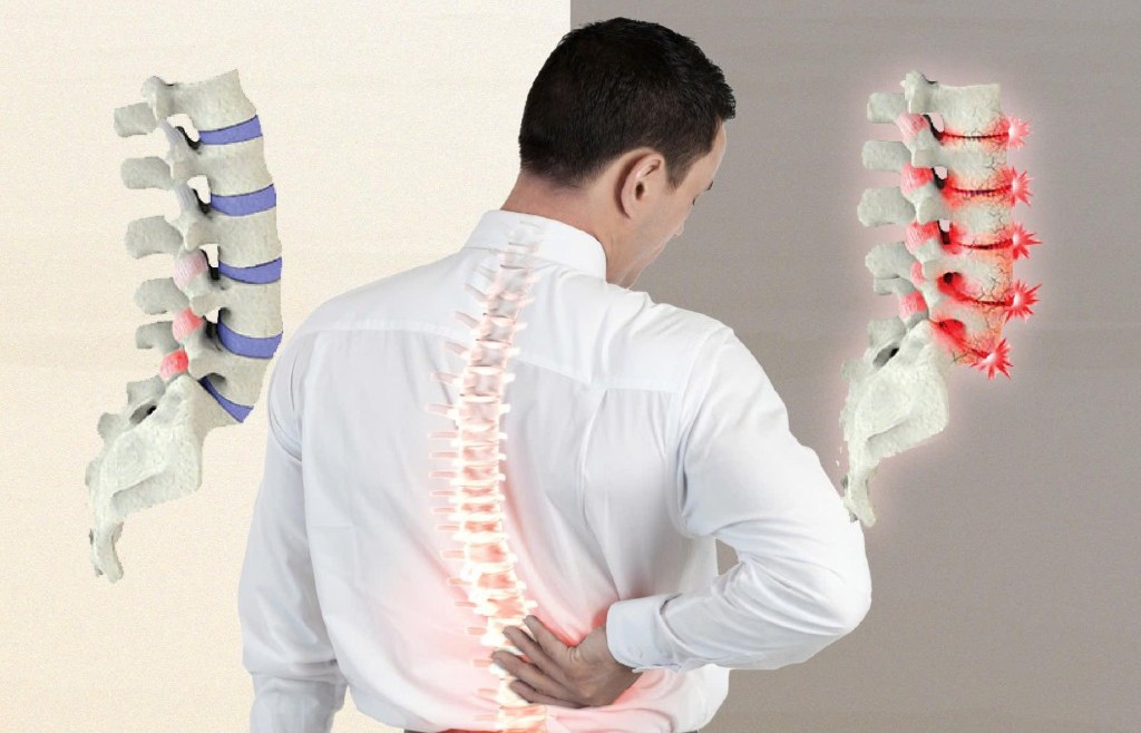 Thoái hóa khớp: Phòng bệnh để giảm gánh nặng cho xương khớp