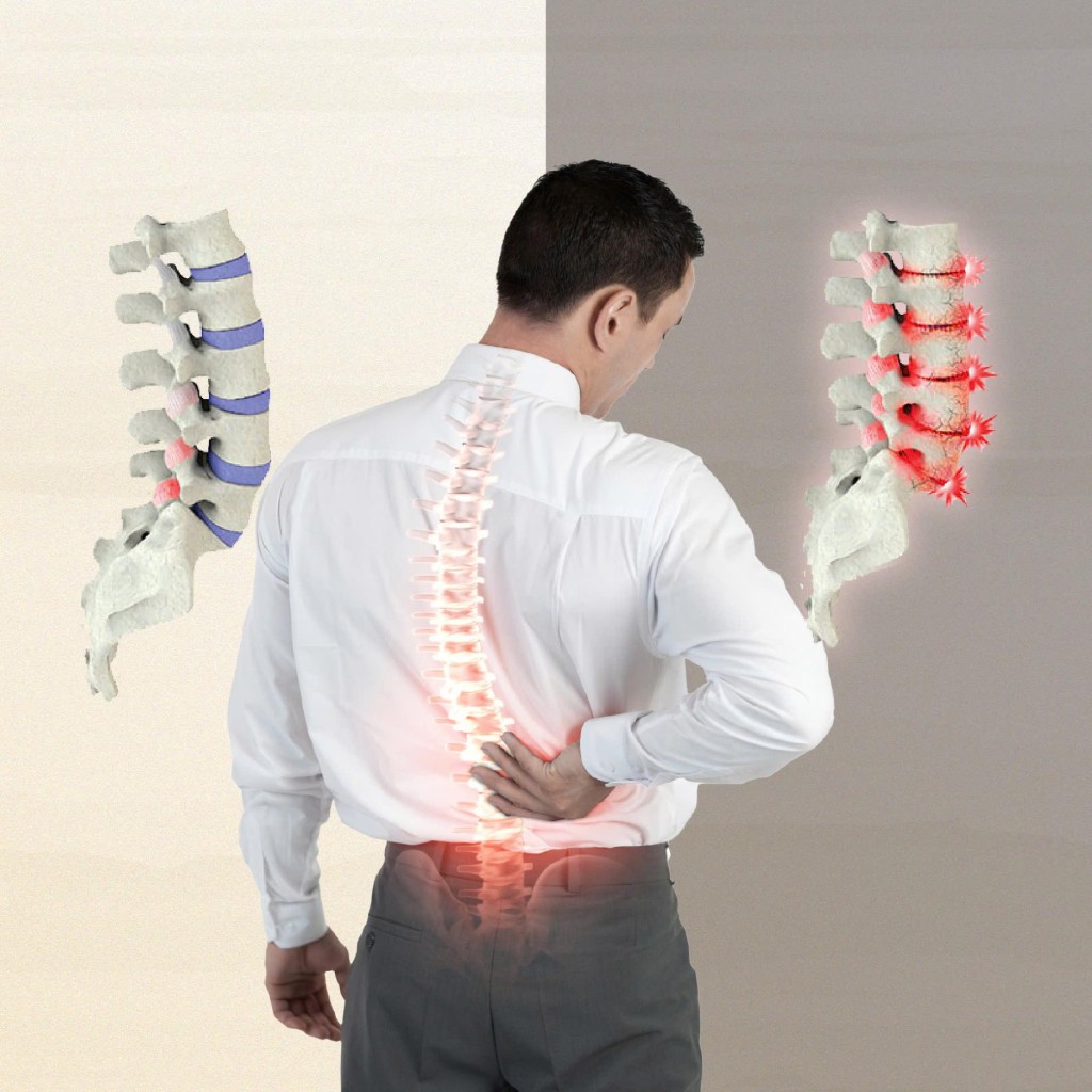 Hình ảnh minh hoạ khớp cột sống thắt lưng bị thoái hoá Hình ảnh minh hoạ khớp cột sống thắt lưng bị thoái hoá