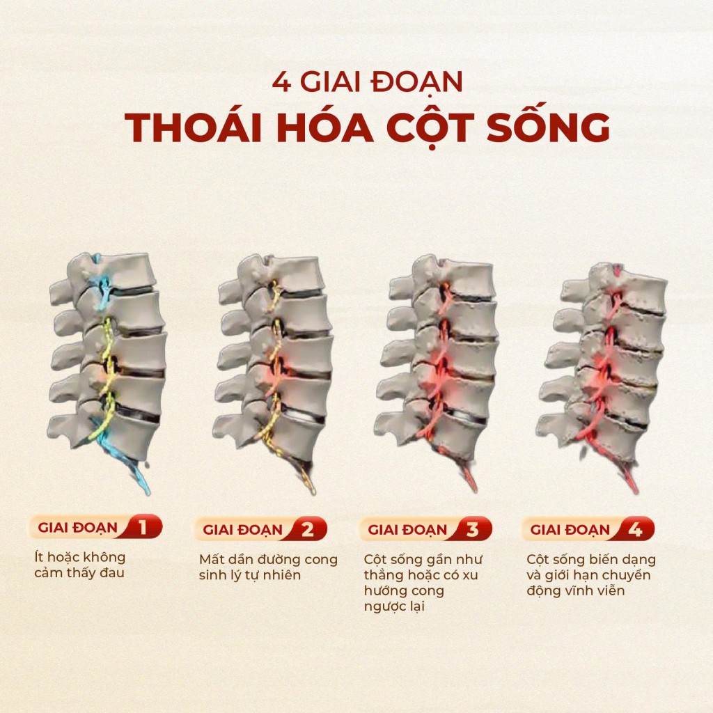 Thoái hóa khớp: Phòng bệnh để giảm gánh nặng cho xương khớp Thoái hóa khớp: Phòng bệnh để giảm gánh nặng cho xương khớp