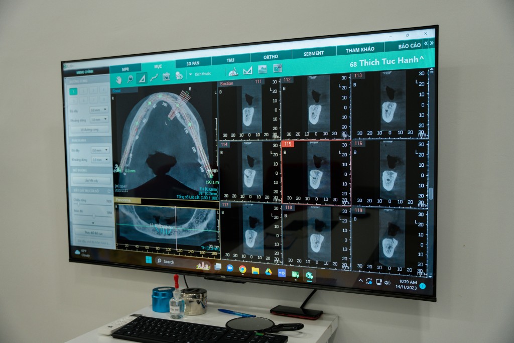 Cấy ghép Implant toàn hàm: 