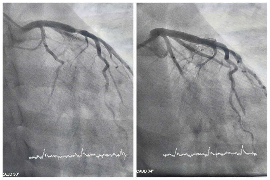 Hình ảnh hẹp tắc động mạch liên thất trước của bệnh nhân được can thiệp tái thông