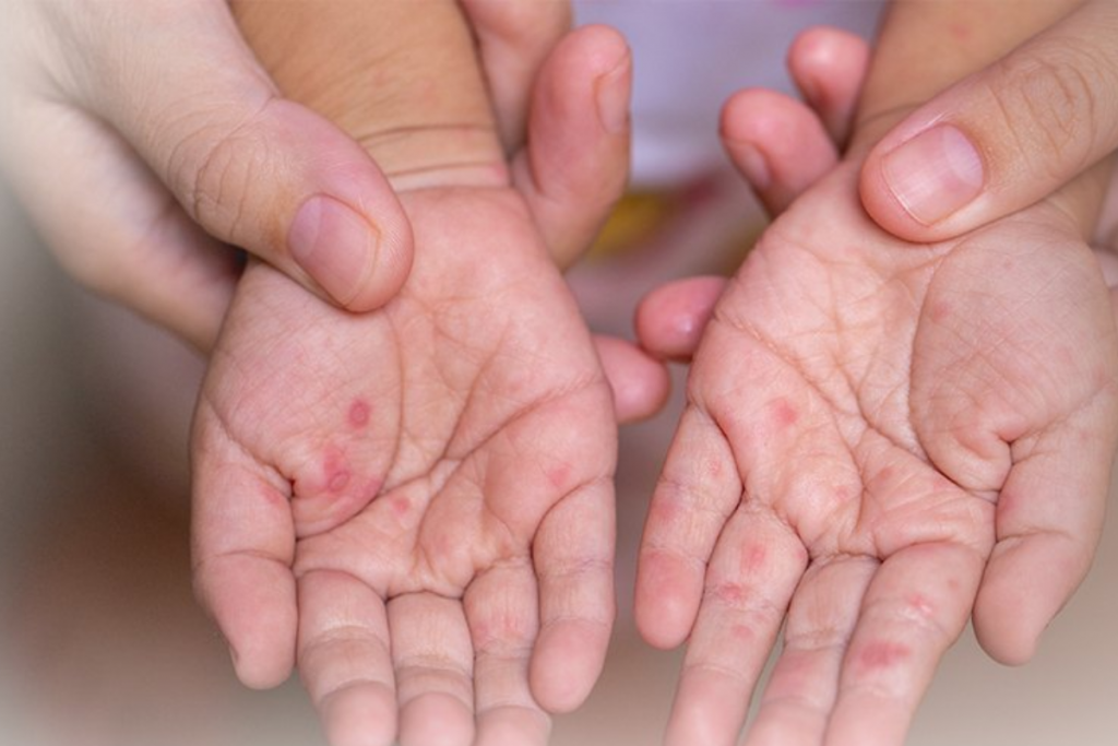 Số ca mắc sốt xuất huyết và tay chân miệng tại TP Hồ Chí Minh đều giảm đáng kể so với trung bình 4 tuần trước đó (ảnh minh họa)