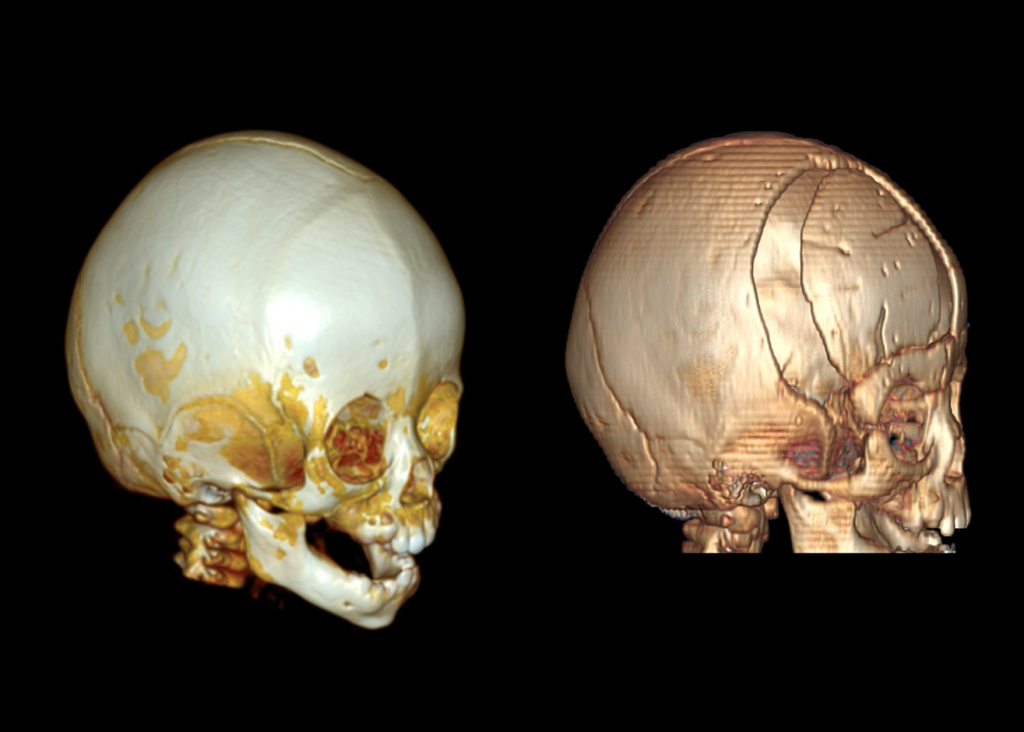 Phim chụp cắt lớp dựng hình 3D trước phẫu thuật (bên trái) và sau phẫu thuật (bên phải) của bé M.T.
