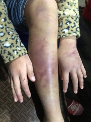 Từ vụ việc mẹ ruột bạo hành bé gái 12 tuổi: Hãy nghĩ đến con trẻ trong cuộc hôn nhân