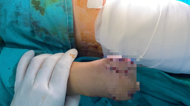 Phú Thọ: Một học sinh THCS bị dập nát bàn tay do pháo tự chế phát nổ