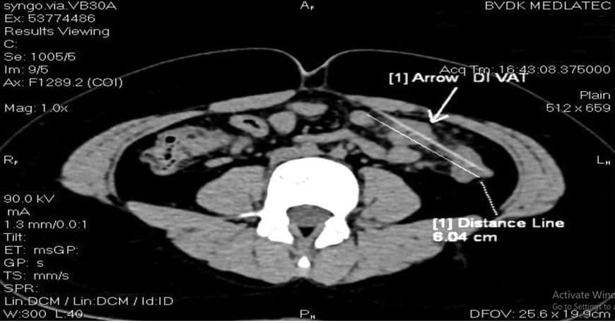 Chiếc tăm dài 6cm đâm xuyên quai ruột non và đại tràng bên trái trên hình ảnh chụp CT 