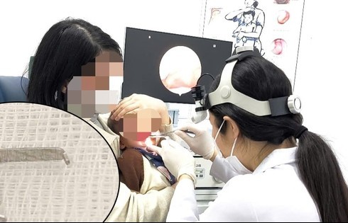 Cấp cứu bé trai bị ghim sắc nhọn mắc trong họng