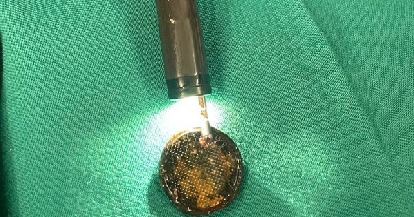 Gắp dị vật pin cúc áo kẹt trong thực quản trẻ nhỏ