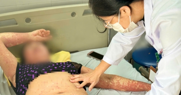 Bệnh nhân bị ứng thuốc nặng khiến men gan tăng 8 lần