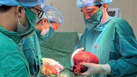 Đi khám vì rong kinh, bụng to bất thường mới phát hiện u xơ tử cung
