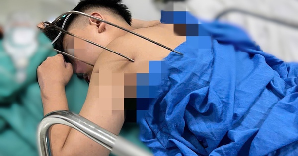 Thanh niên 17 tuổi nguy kịch do dị vật kim loại tự chế xuyên thấu tim