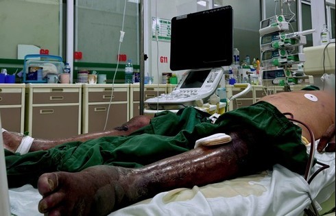 Bị gai đâm khi lội đầm tôm khiến chân hoại tử tím đen