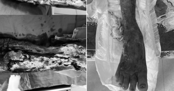 Phòng bệnh do vi khuẩn Aeromonas hydrophila gây ra Phòng bệnh do vi khuẩn Aeromonas hydrophila gây ra