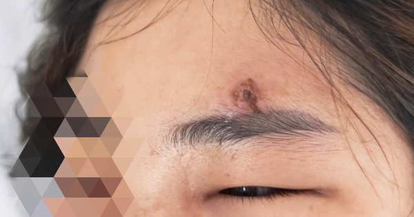 Việc tự ý nặn mụn, đặc biệt là bằng tay chưa vệ sinh sạch sẽ, dễ làm tổn thương da, khiến vi khuẩn có cơ hội xâm nhập sâu, gây viêm mô bào. Ảnh: BVCC