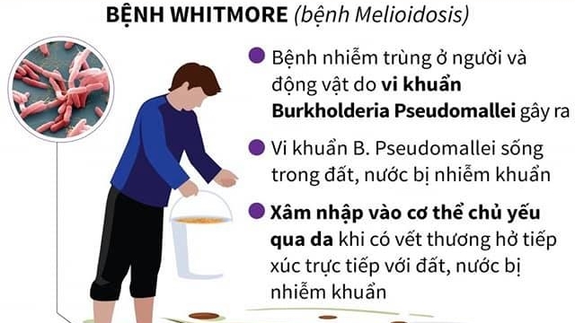 Bộ Y tế khuyến cáo phòng bệnh Whitmore (bệnh Melioidosis)