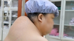Phẫu thuật bệnh nhân có u mỡ "khủng" gây biến dạng vùng vai gáy