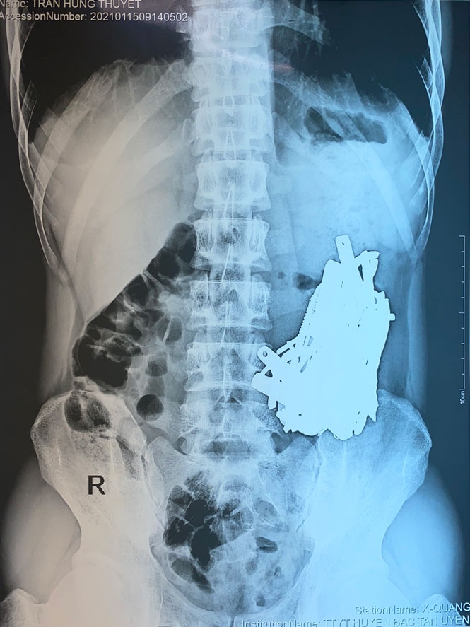 Do trầm cảm, người này đã ăn các dị vật kim loại và chịu cảnh đau bụng kéo dài 1 tháng
