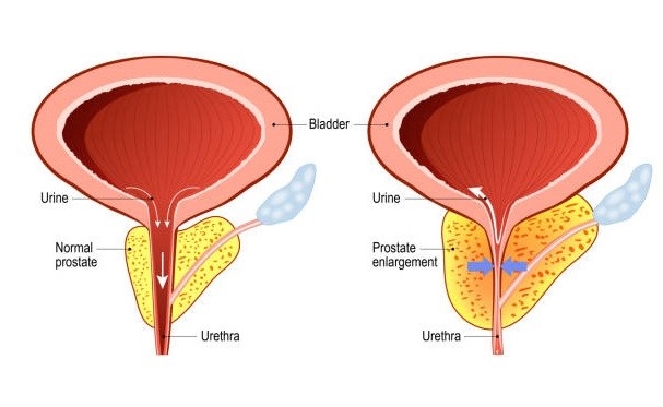 Hình ảnh tuyến tiền liệt bị phì đại (bên phải)