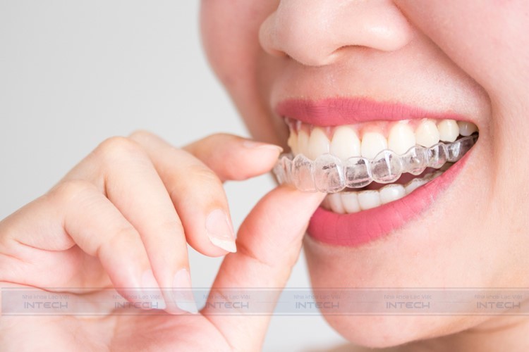 Phương pháp niềng răng trong suốt Invisalign