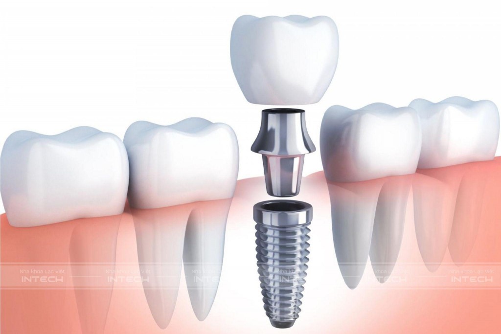 Trồng răng Implant là lựa số 1 một khi mất răng