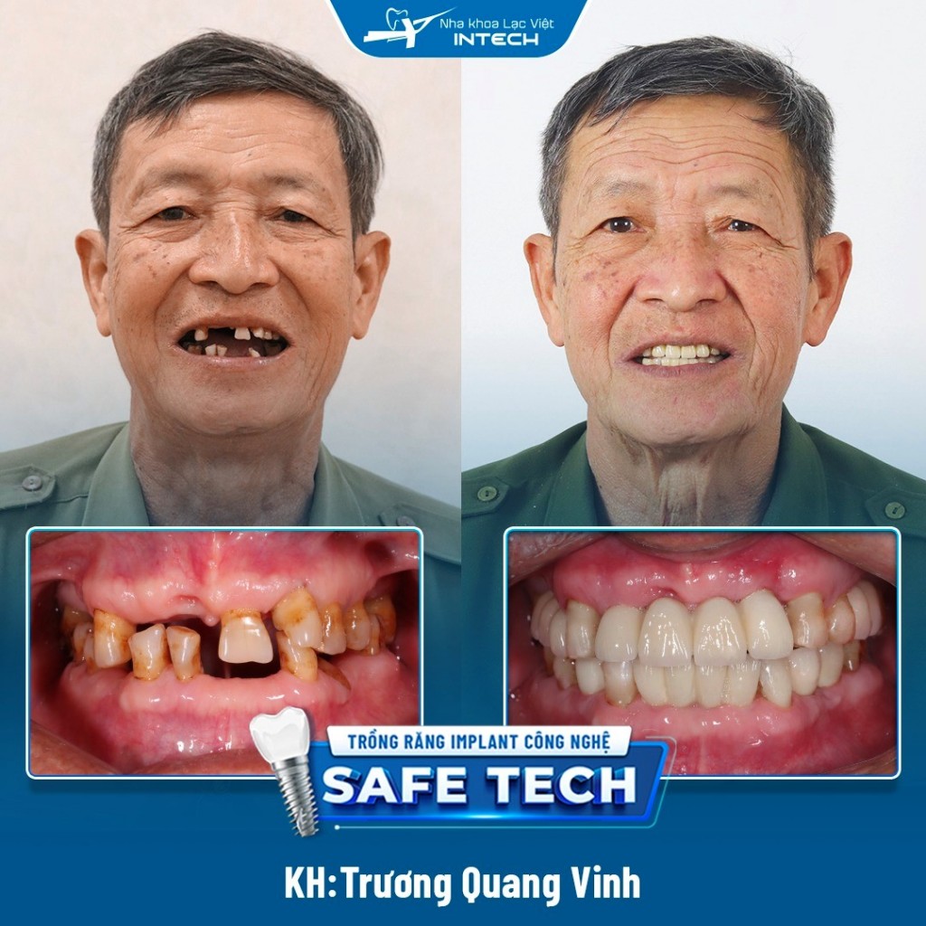 Khách hàng Trương Quang Vinh trước và sau khi phục hình răng Implant