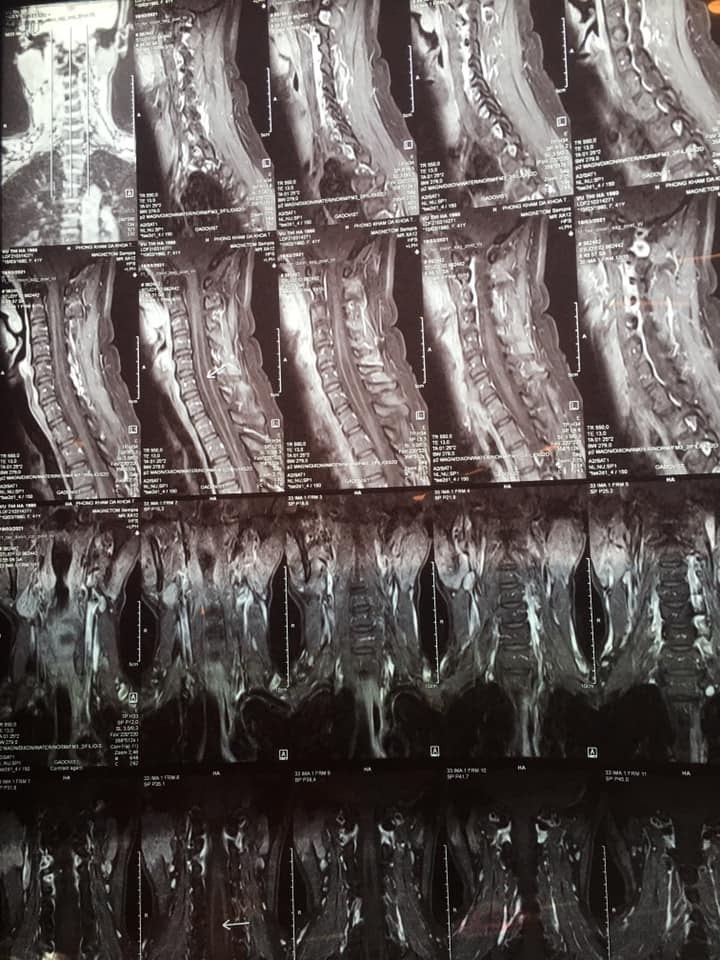   Hình ảnh chụp MRI cổ ,cho thấy hình ảnh xâm lấn tủy 