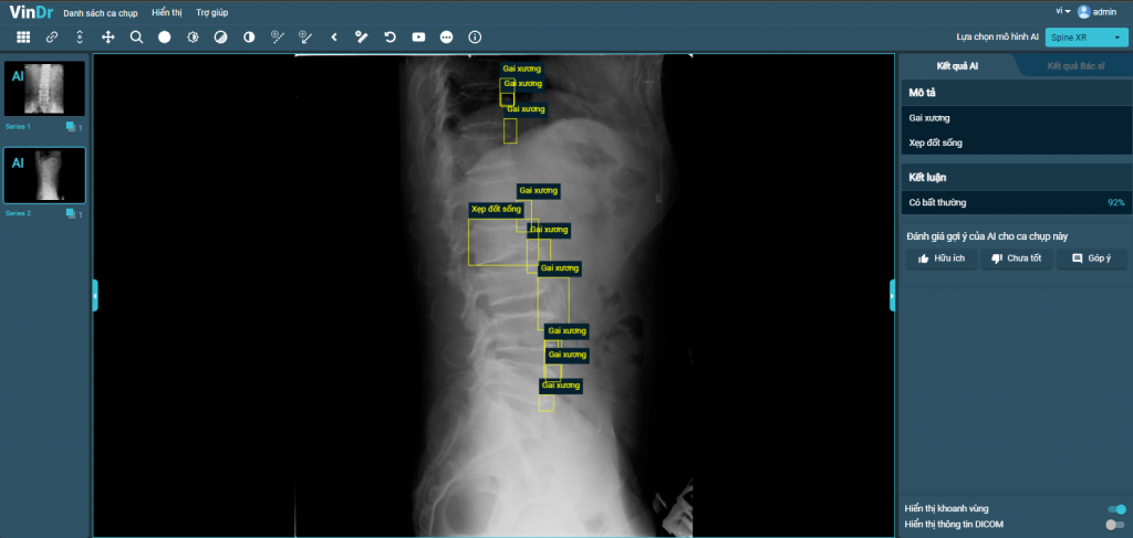 VinDr hoàn thiện tính năng mới SpineXR, hỗ trợ chẩn đoán ảnh X-quang cột sống với độ chính xác khoảng 90%