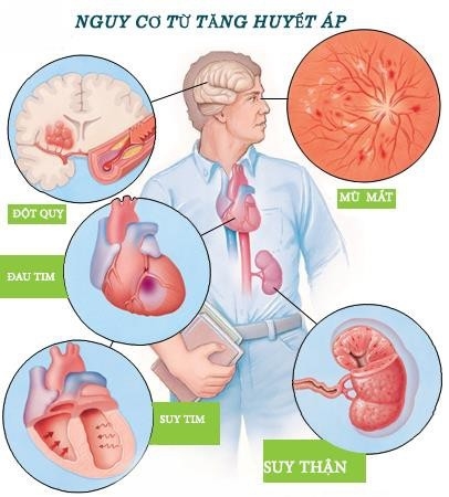 Tăng huyết áp gây ra nhiều biến chứng nghiêm trọng cho cơ thể, ở đó suy tim là hệ quả cuối cùng