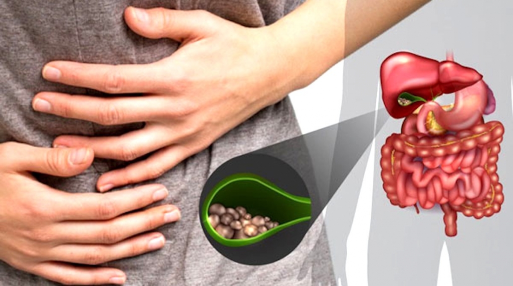Đau bụng là triệu chứng sỏi mật hay bị nhầm thành bệnh dạ dày