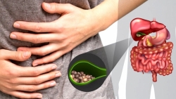 Triệu chứng sỏi mật: Rất dễ nhầm lẫn với bệnh dạ dày!