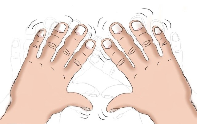 Bệnh run tay khiến người bệnh luôn lóng ngóng, vụng về ngay cả khi làm những việc đơn giản nhất như cầm ly nước, bưng chén cơm