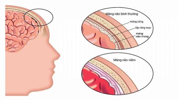 Vĩnh Phúc Cứu sống một bé trai 11 tuổi bị bệnh viêm màng não