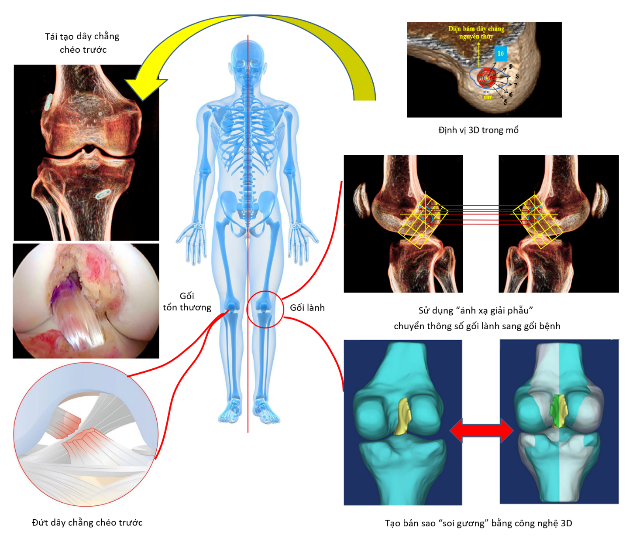 Minh họa phương pháp “ánh xạ giải phẫu” sử dụng công nghệ định vị 3D trong phẫu thuật tái tạo dây chằng chéo trước