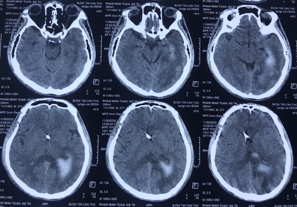Hình ảnh CT sọ não bệnh nhân T sau  can thiệp 