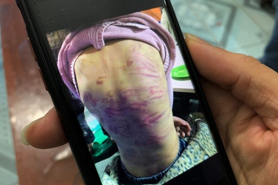 Hình ảnh bé gái 12 tuổi nghi bị mẹ ruột bạo hành.