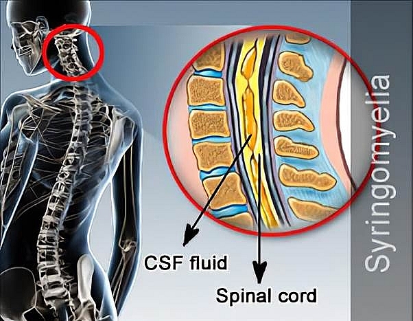 Rỗng tủy do hình thành trong tủy hốc chứa dịch tích lại phát triển dần gây đè ép, tổn thương tủy. (ảnh minh họa) 