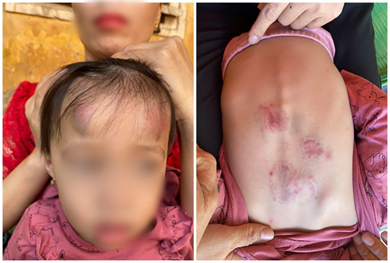 Bé gái 22 tháng tuổi ở Bắc Giang bị bạn đánh đập với nhiều thương tích trên cơ thể