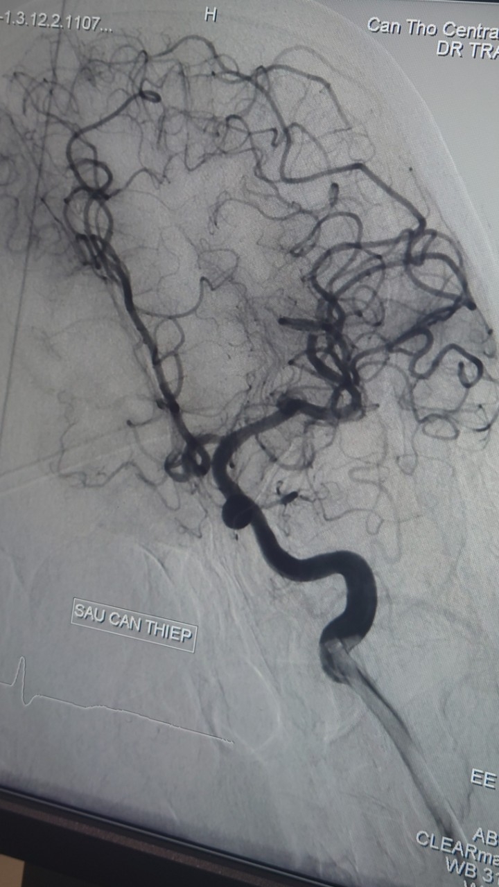 Hình ảnh chụp mạch máu số hóa nền (DSA) động mạch cảnh trong trái (sau can thiệp)