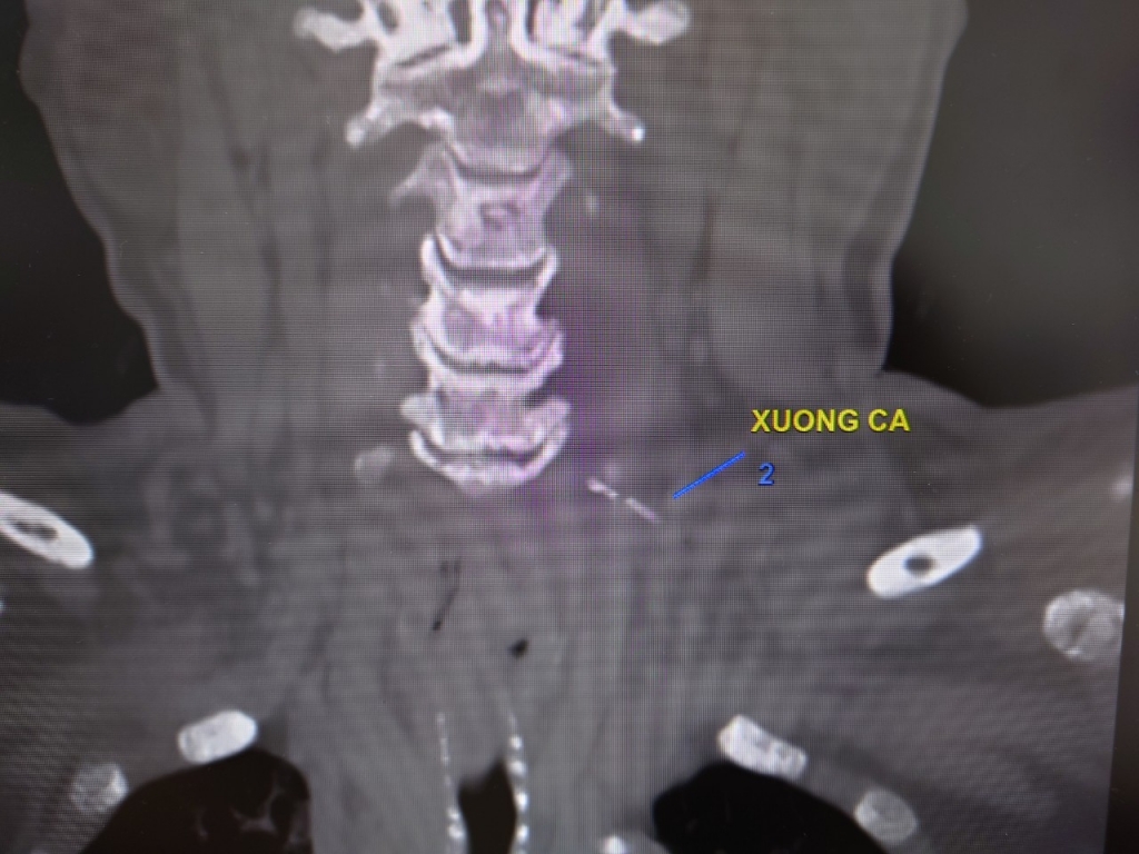 Hình ành xương cá trên CT cột sống cổ