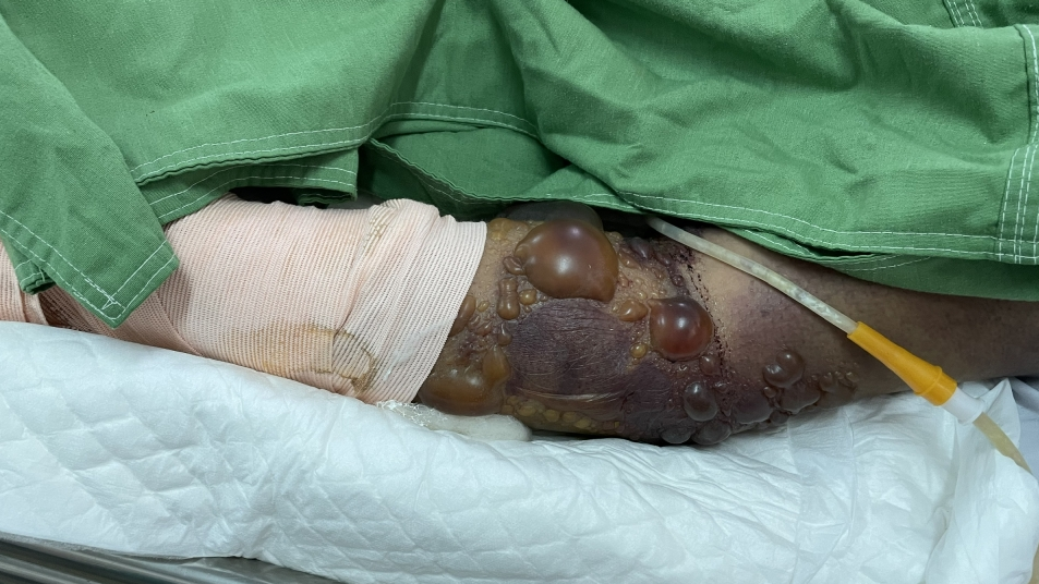 Hình vết cắn của rắn chàm quạp với nhiều bóng nước  bệnh nhân nữ B 52 tuổi