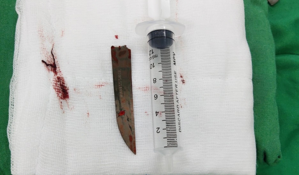 Mang cả mũi dao đâm vào cột sống đến phòng phẫu thuật