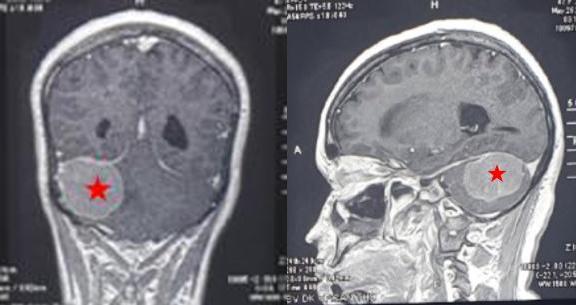 Hình MRI khối trước phẫu thuật