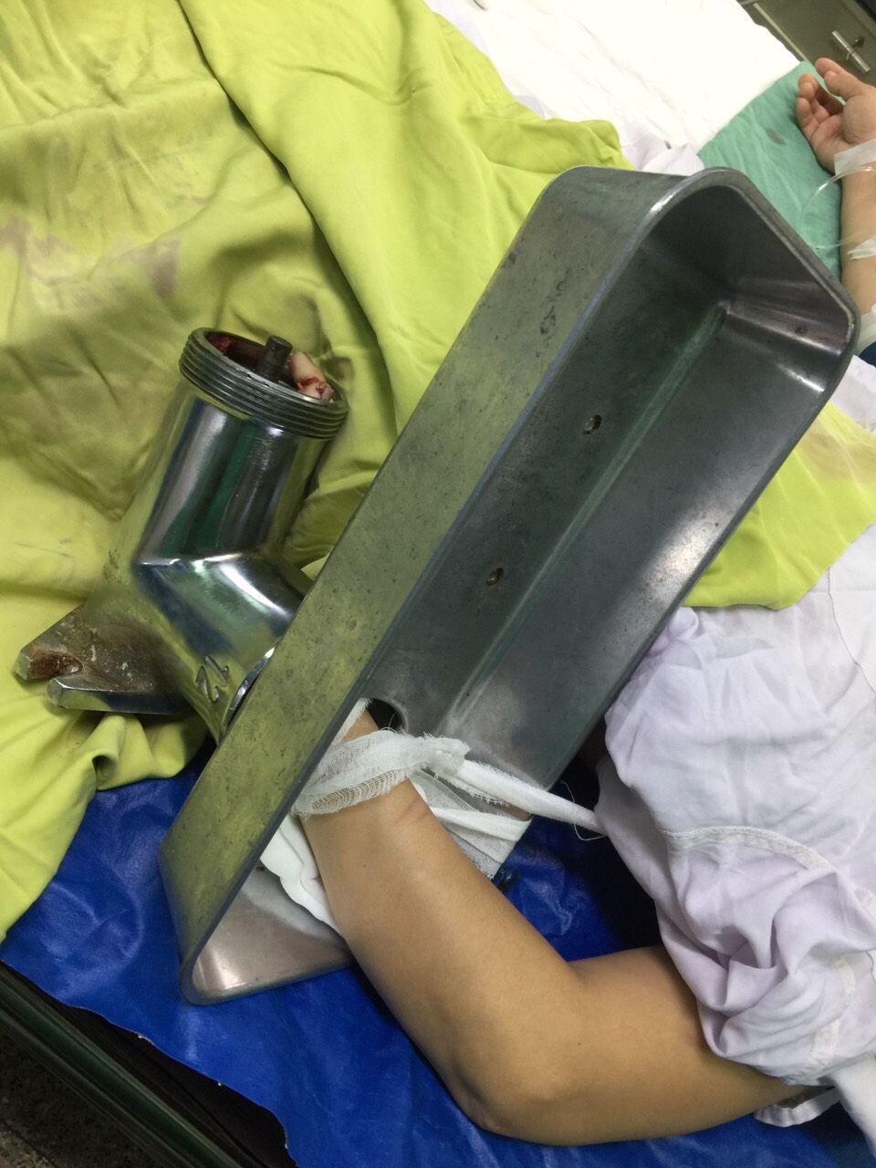 Cấp cứu bệnh nhân bị dập nát bàn tay do máy xay thịt